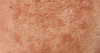 Hiperpigmentimi gjatë verës: Si të mbrojmë lëkurën nga njollat e errëta